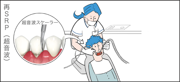 再SRP（超音波）